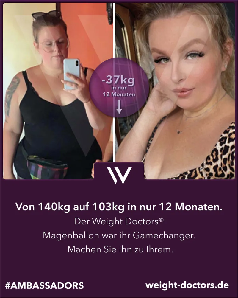 Weight Doctors® Vorher-Nachher: Patientin von 140 kg auf 103 kg in zwölf Monaten, mit dem Weight Doctors® MAGENBALLON