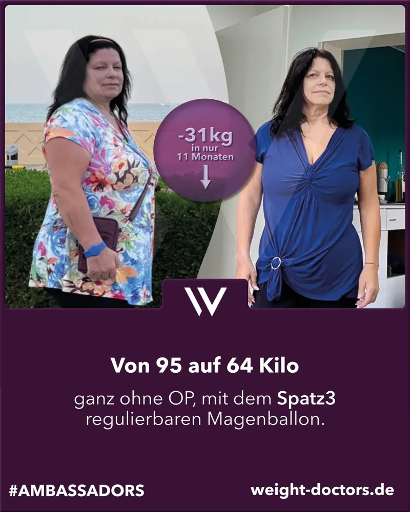 Weight Doctors® Vorher-Nachher: Patientin von 95 auf 64 Kilo ganz ohne OP, mit dem regulierbaren Spatz3-Magenballon