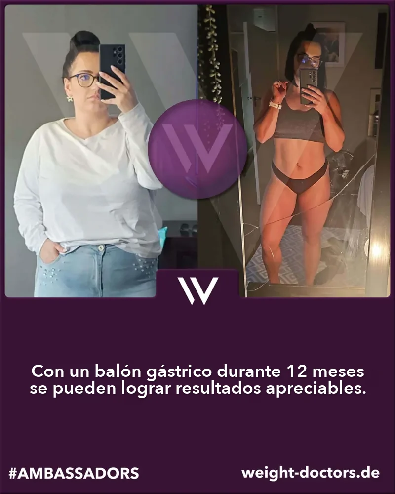 Weight Doctors® antes y después: paciente antes y después de doce meses con el Weight Doctors® BALÓN GÁSTRICO