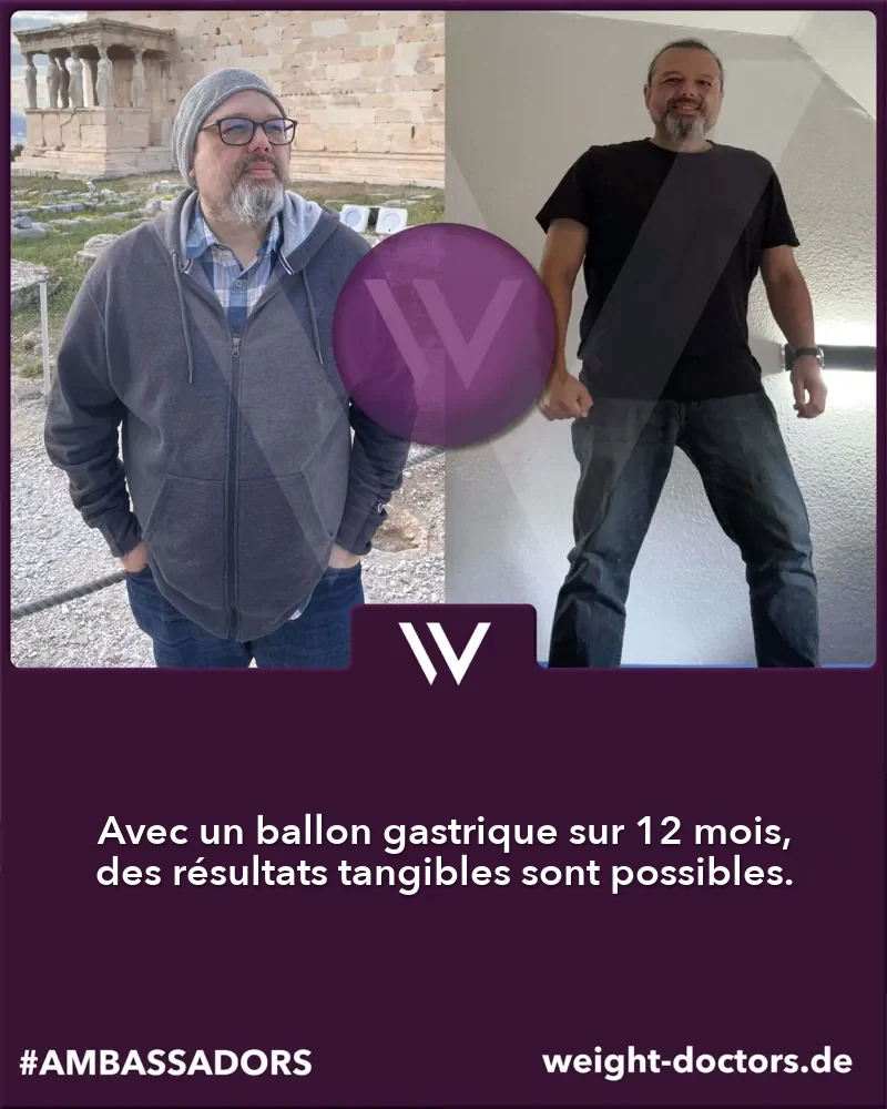 Weight Doctors® avant-après&nbsp;: patient avant et après douze mois avec le Weight Doctors® BALLON GASTRIQUE