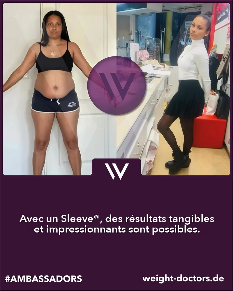 Weight Doctors® avant et après&nbsp;: patiente avant et après son Weight Doctors SLEEVE®