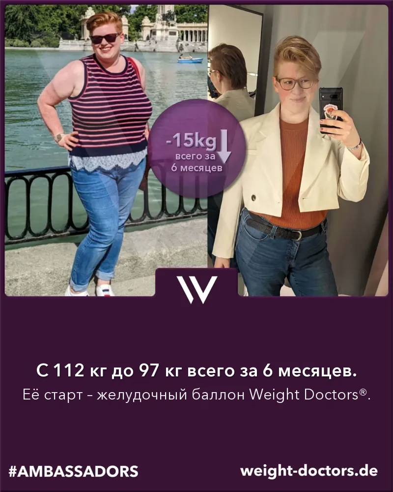 Weight Doctors® до и после: пациентка, со 112 кг до 97 кг за шесть месяцев с Weight Doctors® ЖЕЛУДОЧНЫЙ БАЛЛОН