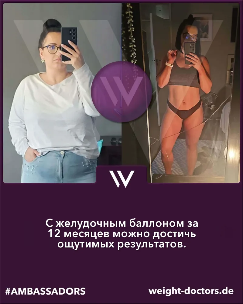Weight Doctors® до и после: пациентка до и через двенадцать месяцев с Weight Doctors® ЖЕЛУДОЧНЫЙ БАЛЛОН