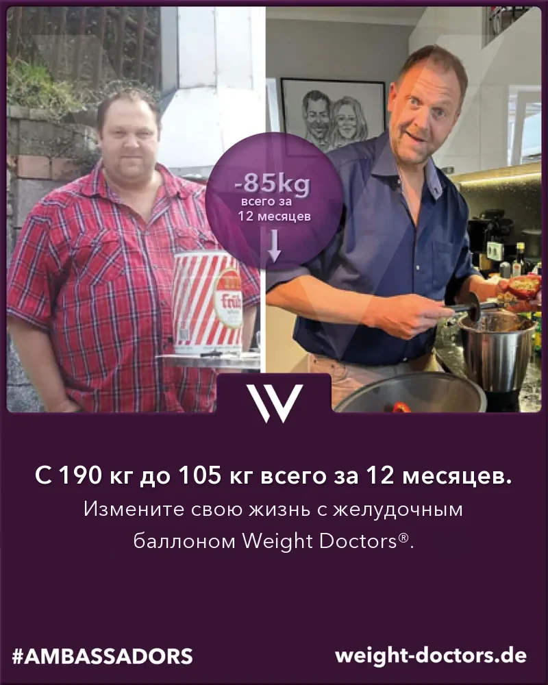 Weight Doctors® до и после: пациент, со 190 кг до 105 кг за двенадцать месяцев с Weight Doctors® ЖЕЛУДОЧНЫЙ БАЛЛОН