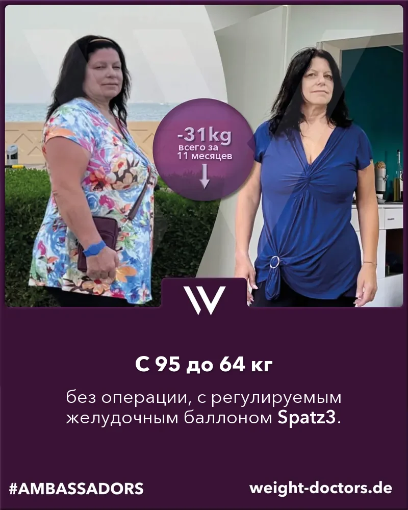 Weight Doctors® до и после: пациентка, с 95 до 64 килограммов совсем без операции, с регулируемым желудочным баллоном Spatz3