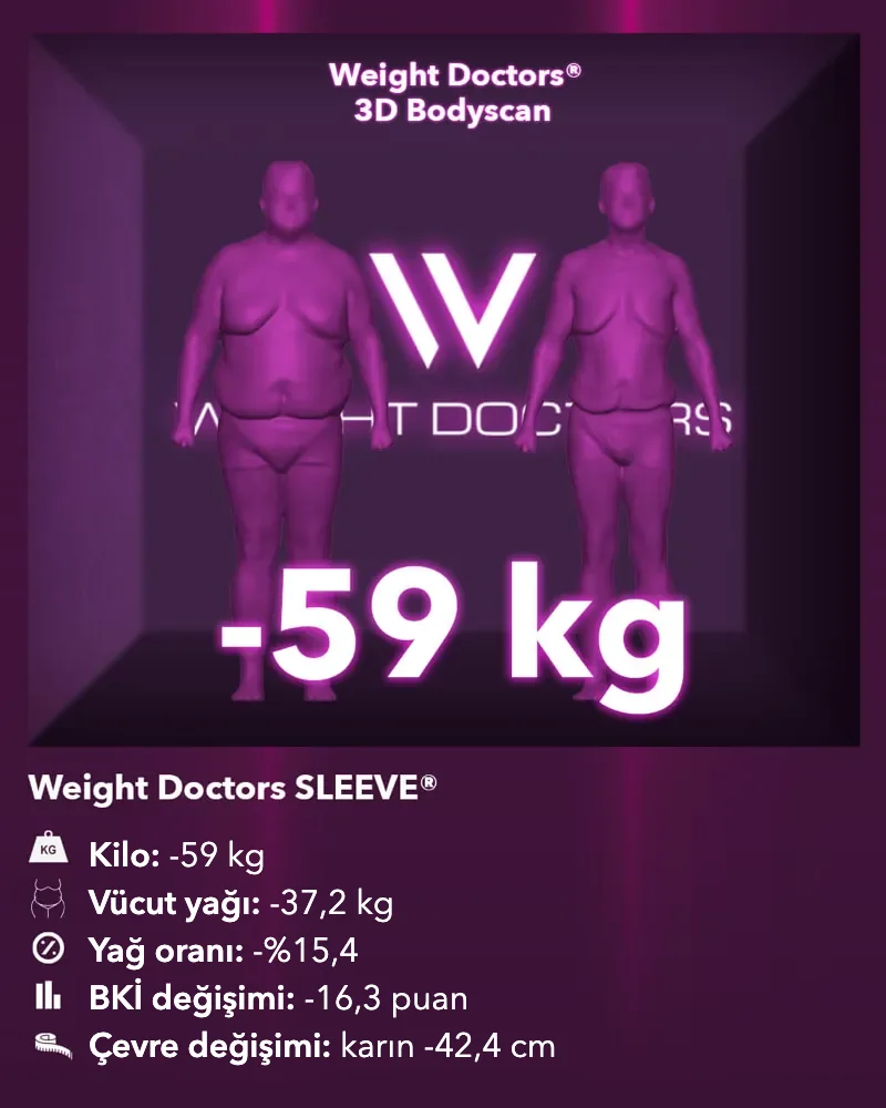 Weight Doctors® 3D Bodyscan öncesi ve sonrası: Weight Doctors SLEEVE® ile 59 kg eksi, vücut yağı 37,2 kg eksi