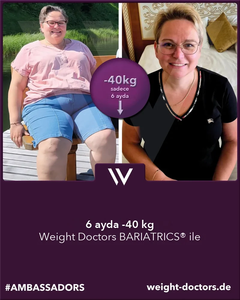 Weight Doctors® öncesi ve sonrası: Weight Doctors BARIATRICS® ile altı ayda 40 kg daha az olan kadın hasta