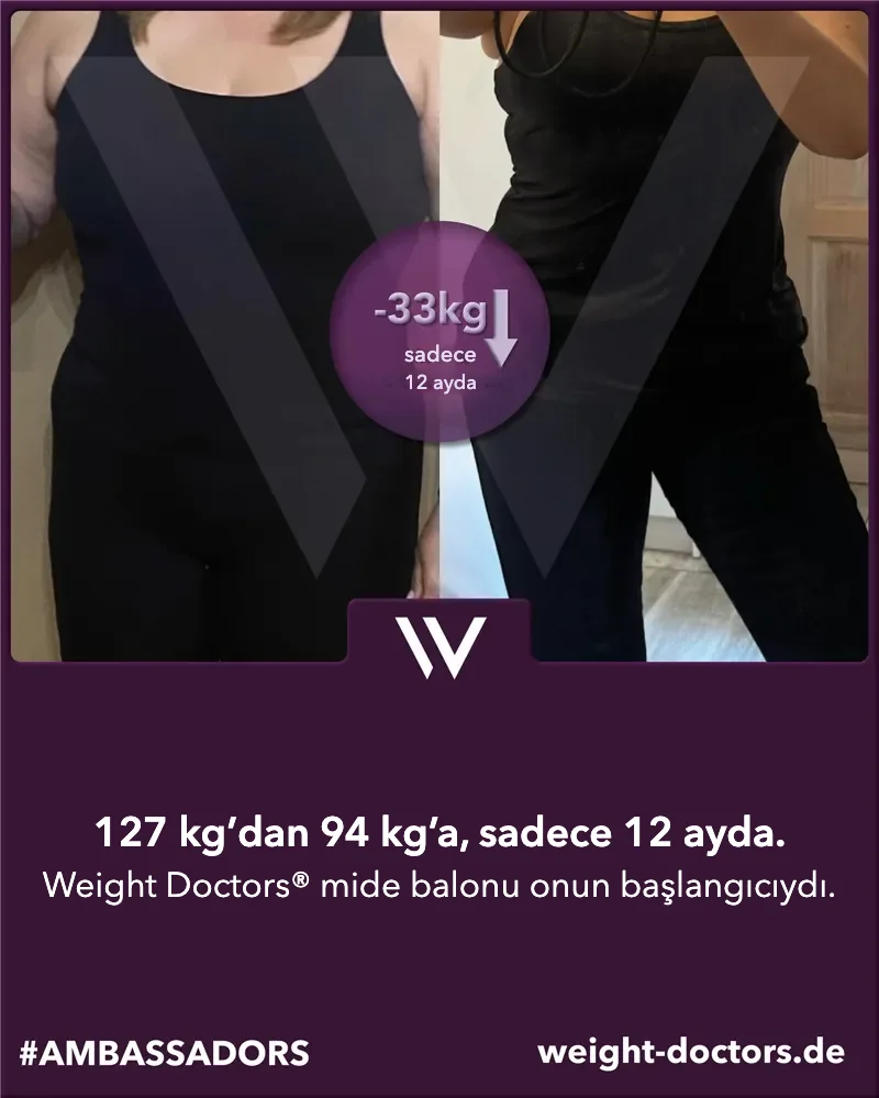 Weight Doctors® öncesi ve sonrası: kadın hasta, on iki ayda 127 kg’dan 94 kg’a, Weight Doctors® MİDE BALONU ile