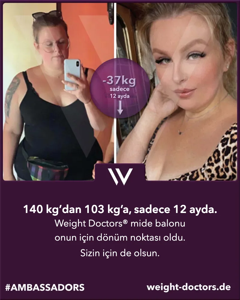 Weight Doctors® öncesi-sonrası: Weight Doctors® MİDE BALONU ile on iki ayda 140 kg’dan 103 kg’a inen bir hasta