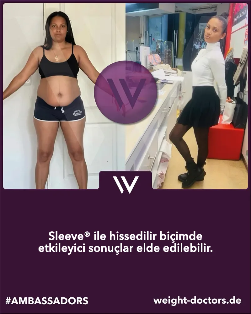 Weight Doctors® öncesi ve sonrası: Weight Doctors SLEEVE® öncesi ve sonrasında kadın hasta
