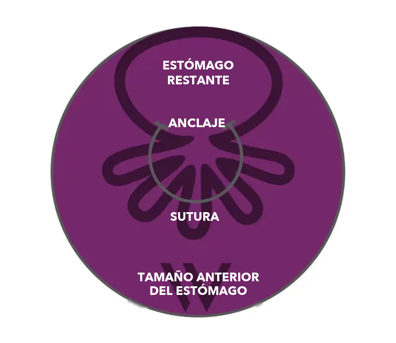 Esquema de OverStitch NXT™: anclajes y sutura recogen la pared del estómago; el estómago restante es claramente más pequeño que el tamaño anterior