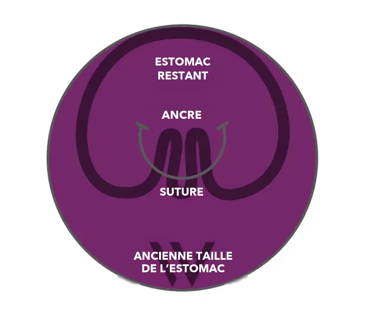 Schéma pose® 3.0 Double Helix&nbsp;: les ancres et la suture plissent la paroi de l’estomac, l’estomac restant est nettement plus petit que l’ancienne taille de l’estomac
