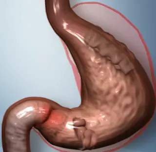Estómago tras el procedimiento pose® con pliegues en la parte superior y antes de la salida del estómago, con el tamaño anterior del estómago rodeado en rojo
