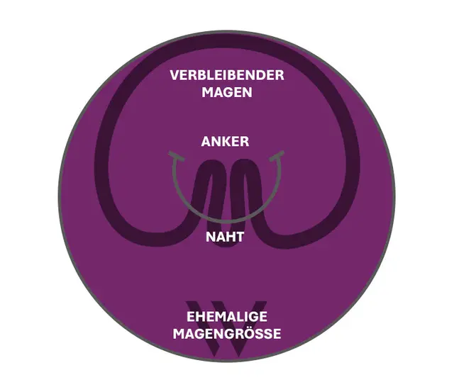 Schema pose® 3.0 Double Helix: Anker und Naht falten die Magenwand, der verbleibende Magen ist deutlich kleiner als die ehemalige Magengröße
