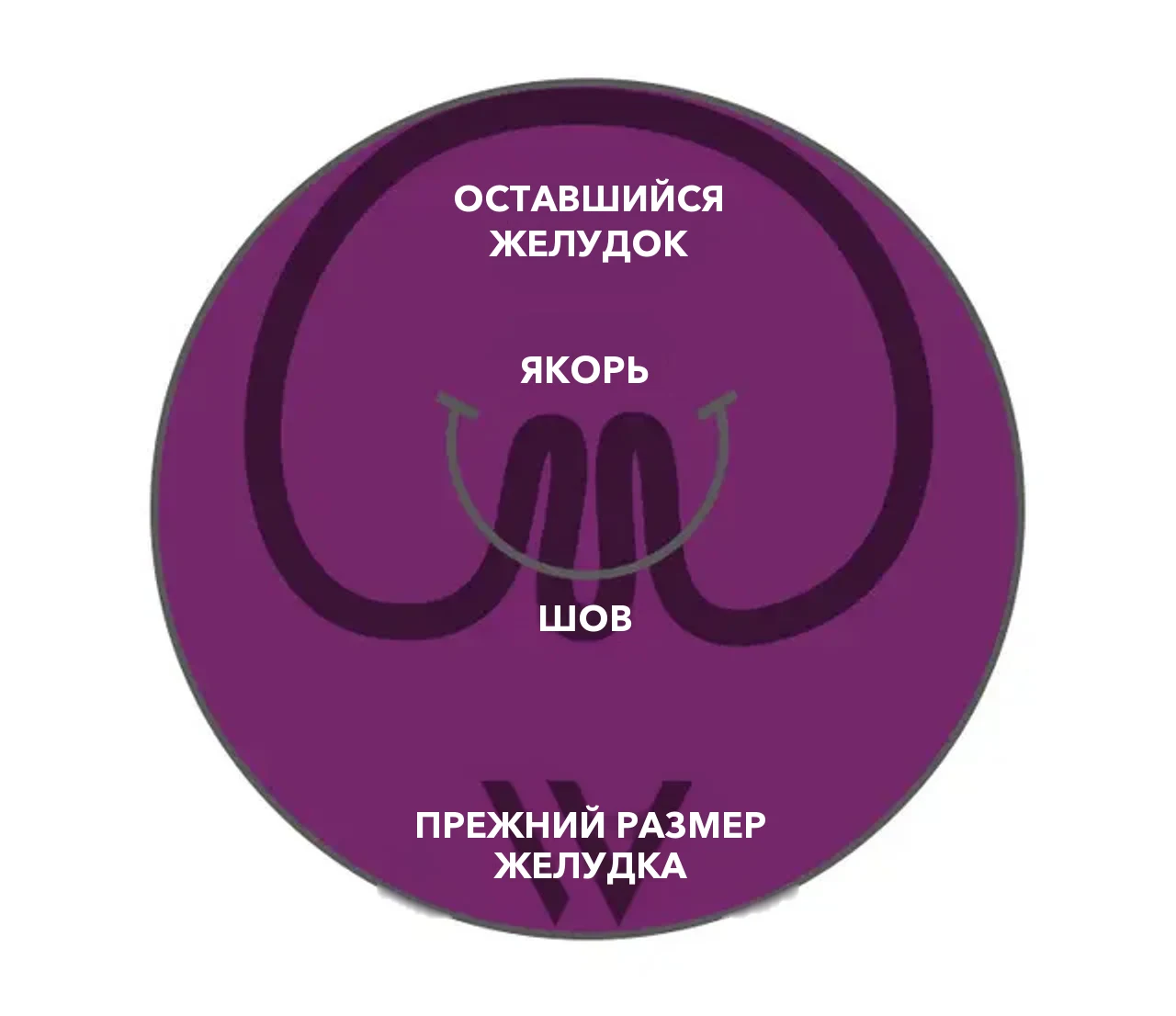 Схема pose® 3.0 Double Helix: якоря и шов собирают стенку желудка в складки, оставшийся желудок значительно меньше прежнего размера