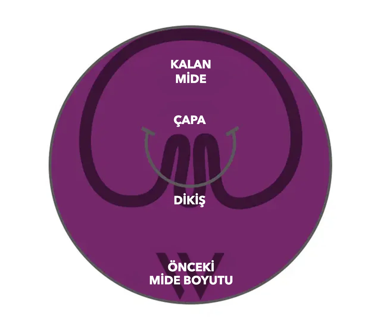 pose® 3.0 Double Helix şeması: Çapa ve dikiş mide duvarını katlar, kalan mide önceki mide boyutundan belirgin biçimde daha küçüktür