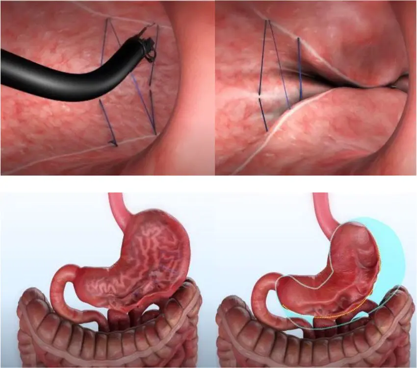 Endoskopische Naht mit OverStitch NXT™: oben das Endoskop beim Nähen an der Magenwand, unten der Magen vorher und danach mit der früheren Größe markiert