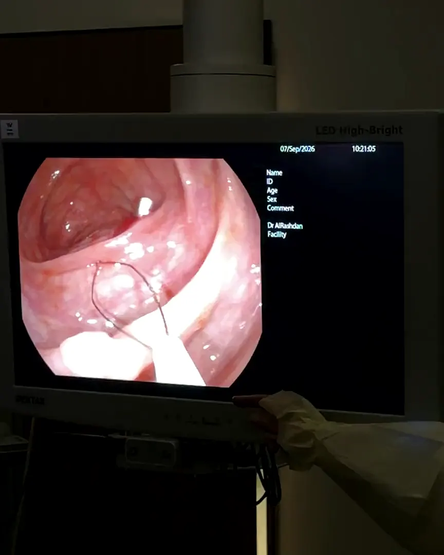 Monitor mit dem Kamerabild aus dem Magen während einer Magenspiegelung